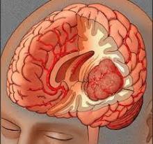 brain_tumors