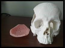 cranioplasty