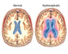 hydrocephalus