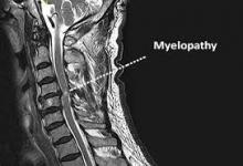 myelopathy