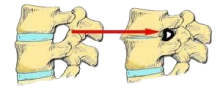 spinal_stenosis