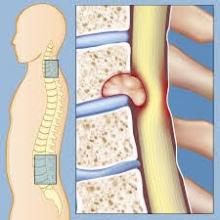 spinal_tumors